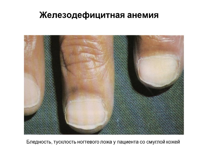 Железодефицитная анемия Бледность, тусклость ногтевого ложа у пациента со смуглой кожей